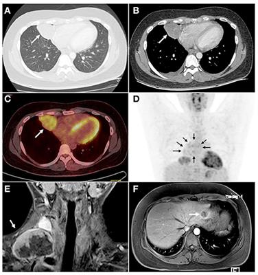 Case Report and Literature Review: Pulmonary Sclerosing Pneumocytoma With Multiple Metastases Harboring AKT1 E17K Somatic Mutation and TP53 C176Y Germline Mutation